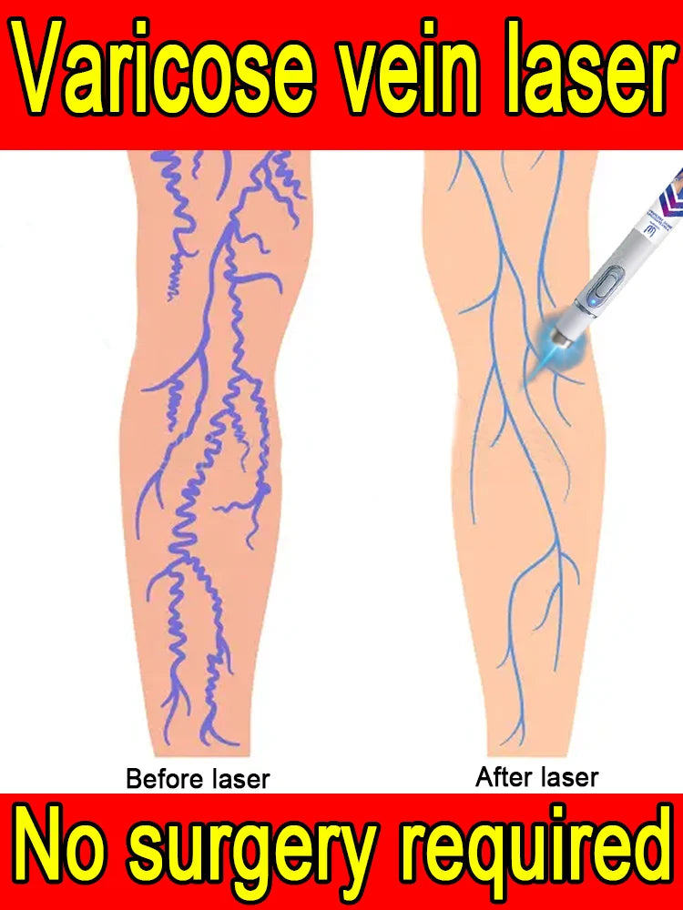 2nd generation varicose vein laser eliminates vasculitis and phlebitis, relieves spider leg pain, laser pointer for treatment