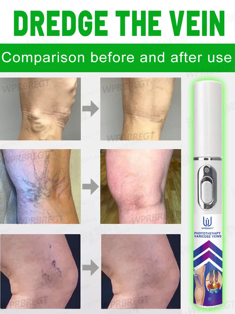 2nd generation varicose vein laser eliminates vasculitis and phlebitis, relieves spider leg pain, laser pointer for treatment