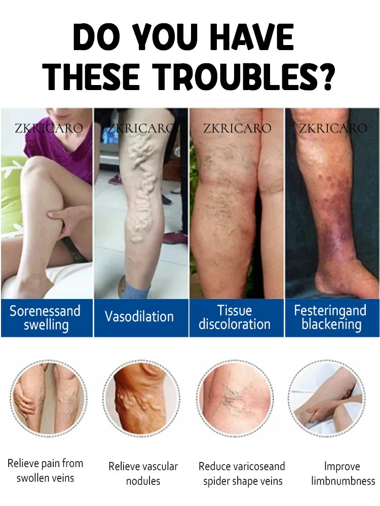 2nd generation varicose vein laser eliminates vasculitis and phlebitis, relieves spider leg pain, laser pointer for treatment